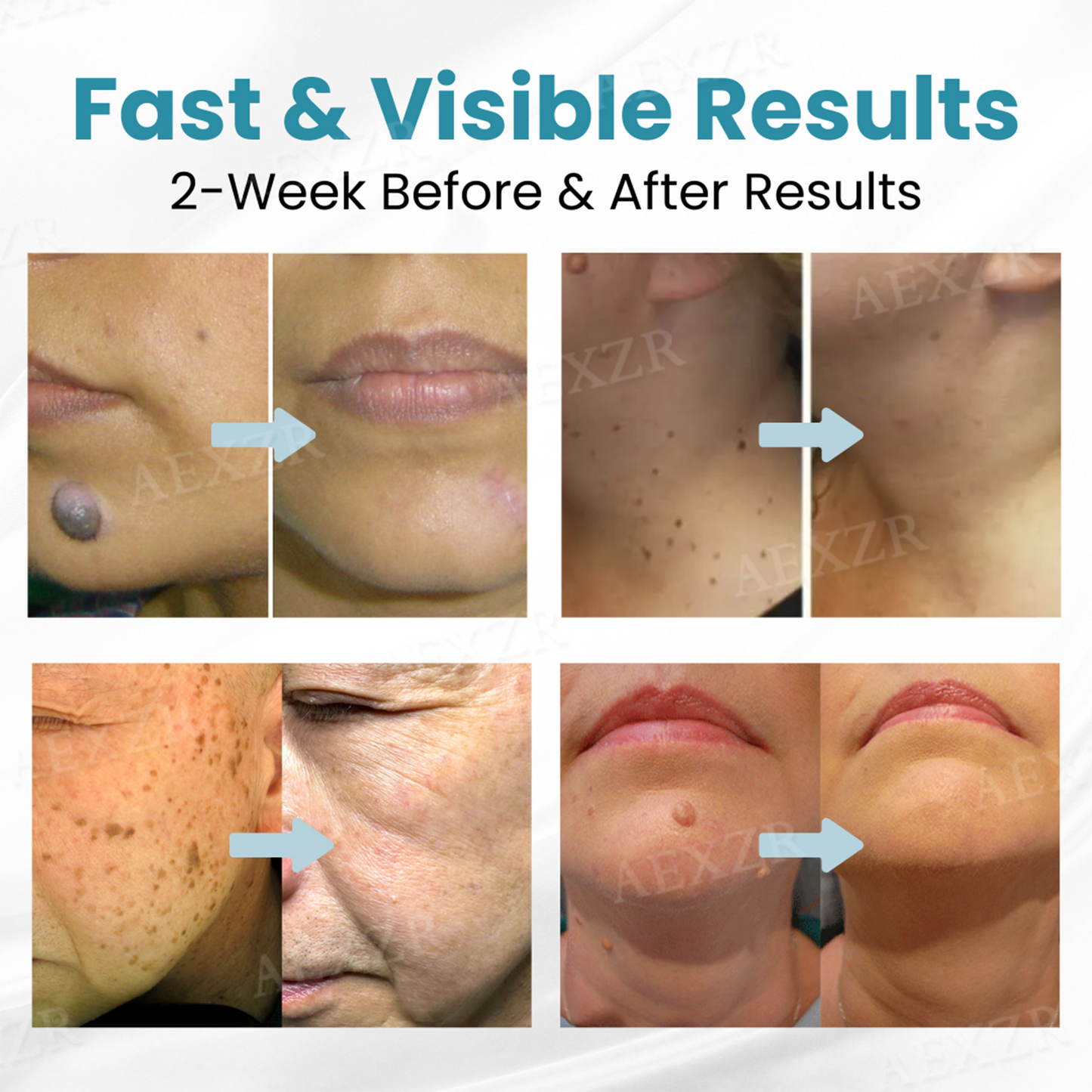 Bkenda® Non-Invasive Mole and Wart Removal Laser Pen