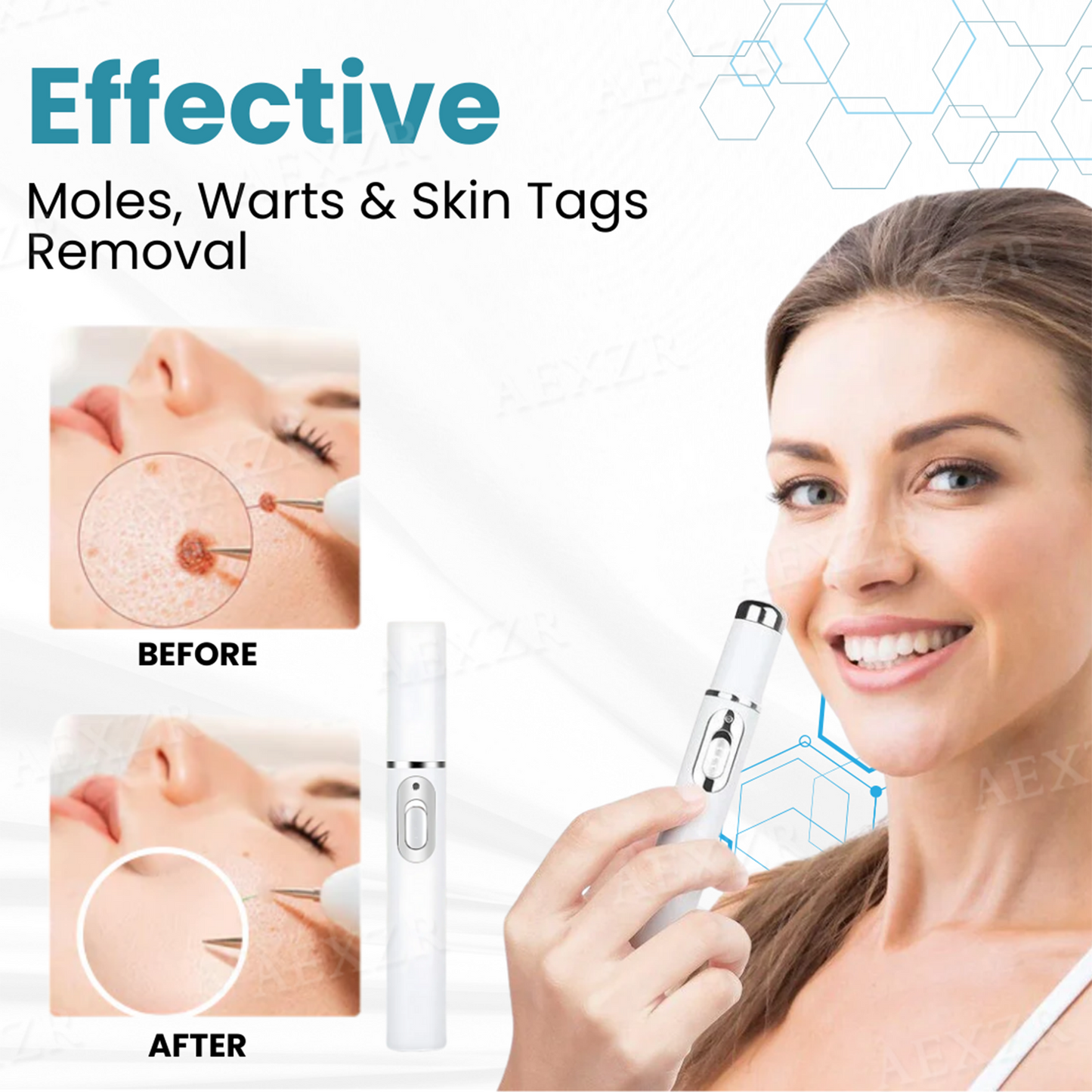 Bkenda® Non-Invasive Mole and Wart Removal Laser Pen